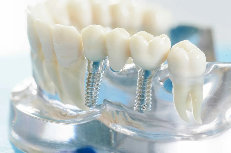 Что такое протезирование зубов. Методы протезирования