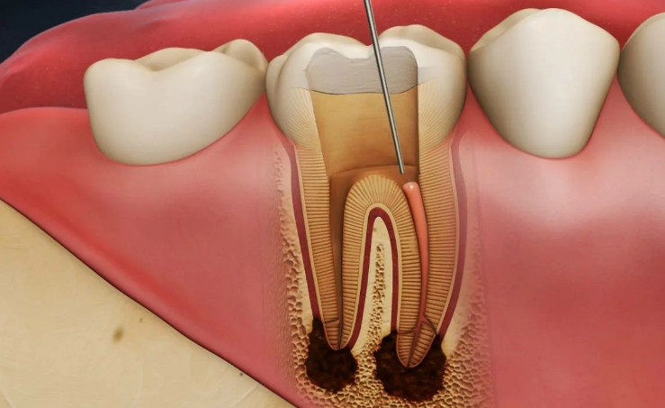 Как лечить воспаление зуба