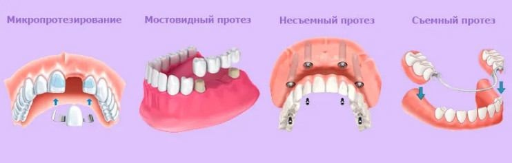 Микропротезирование зубов. Что это?