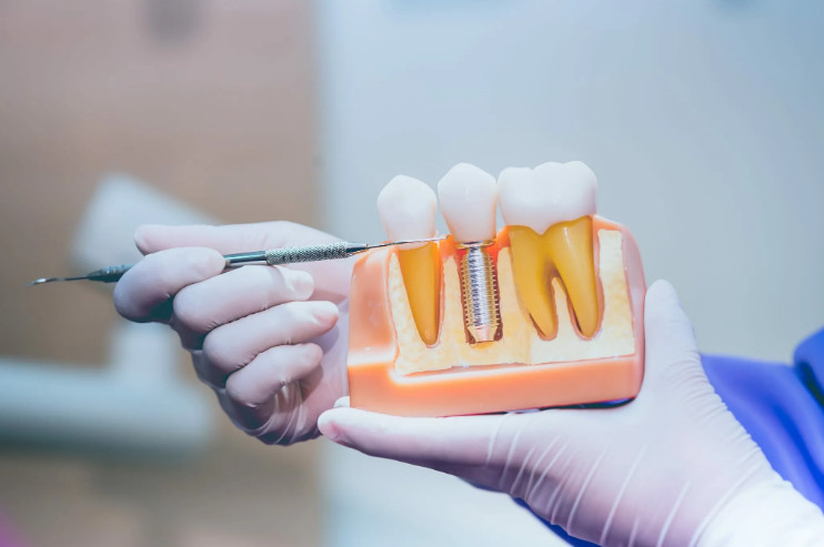 Безопасная имплантация зубов