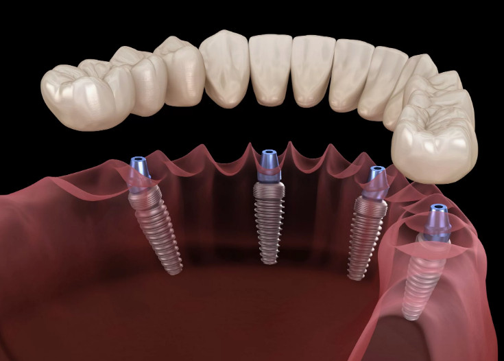 Способы восстановления потерянного зуба
