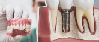 Способы восстановления потерянного зуба