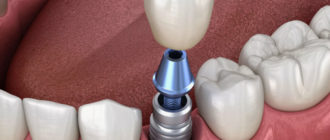 Металлокерамическая коронка: идеальное решение для восстановления зубов
