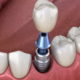Металлокерамическая коронка: идеальное решение для восстановления зубов